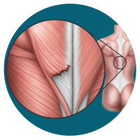 מתיחת שרירים